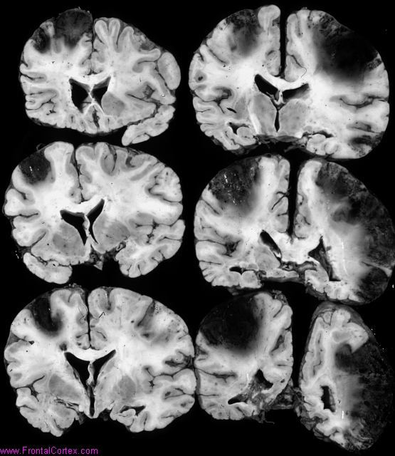 Bilateral venous infarcts, multiple coronal sections.